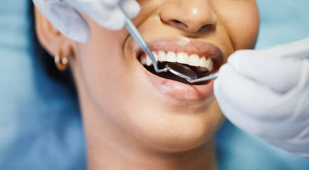 Best Emergency Dentist for Lost Fillings or Crowns in Euharlee, GA